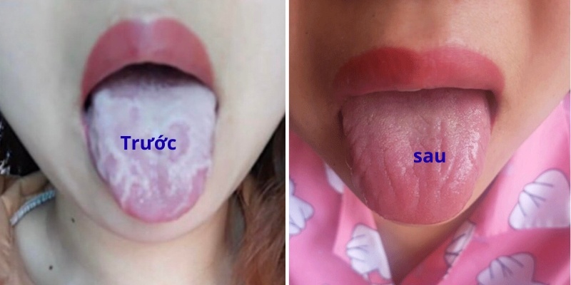 Sau điều trị lưỡi phải hết sạch nấm và hồng hào trở lại.